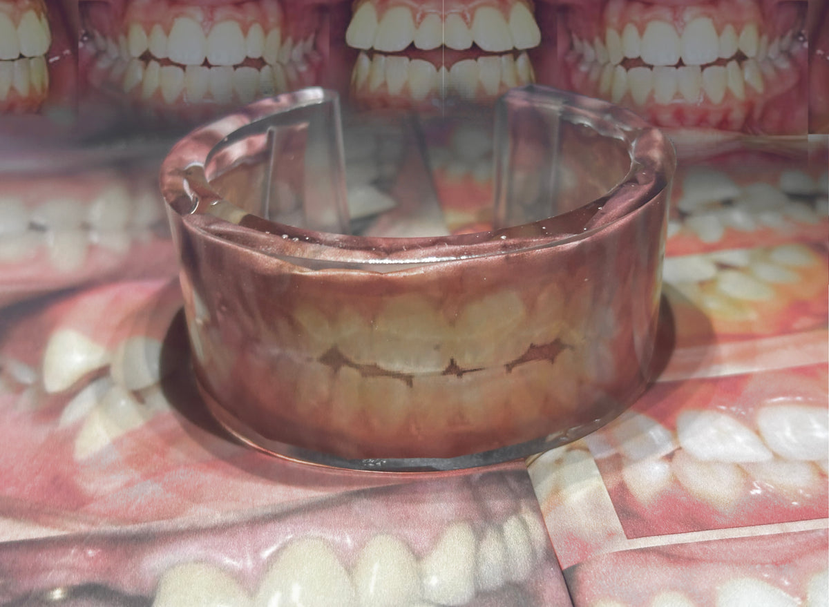 Overbite